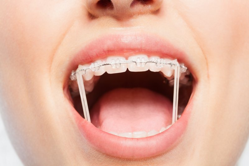 Wigal Orthodontics Blog