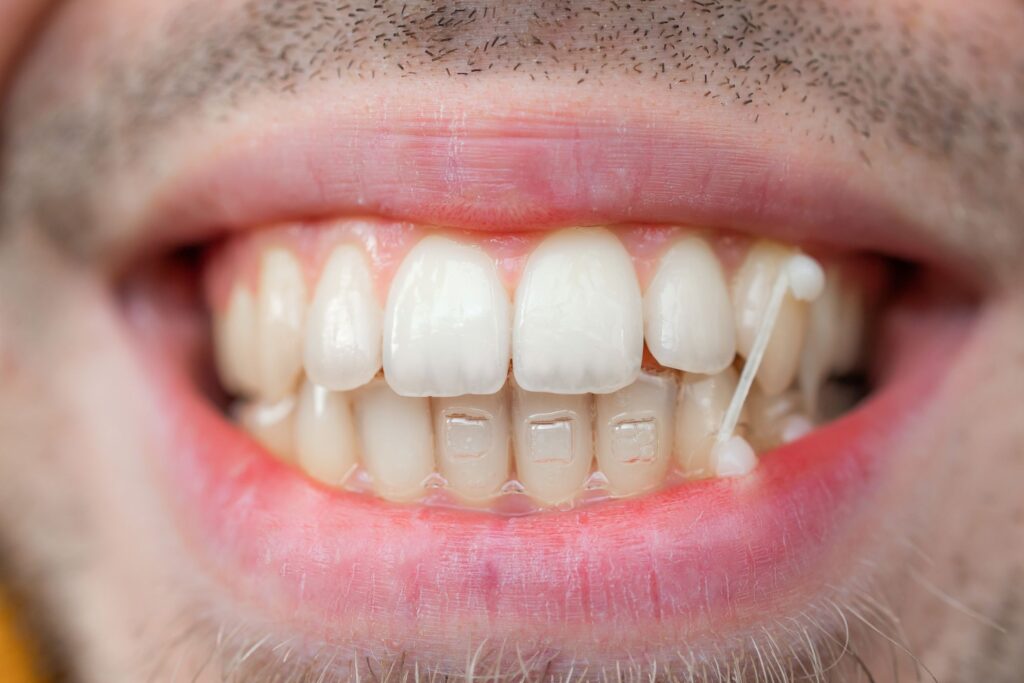 Closeup of Invisalign attachments on a man's teeth